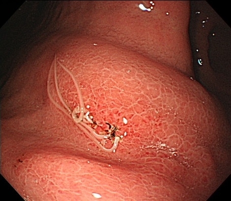 写真①胃カメラで見ると、このように虫体の一端を粘膜に刺し込んでいる様子がみられます。この症例では、同時に3匹のアニサキス虫体が認められました。